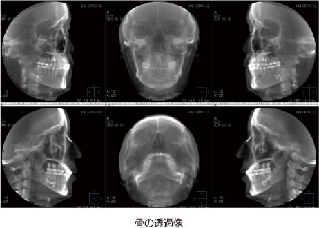 画像｜骨の透過像