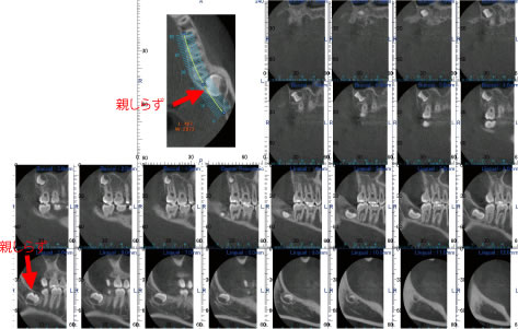 画像｜耳鼻疾患の断面像2