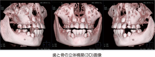画像｜歯と骨の立体構築（3D）画像