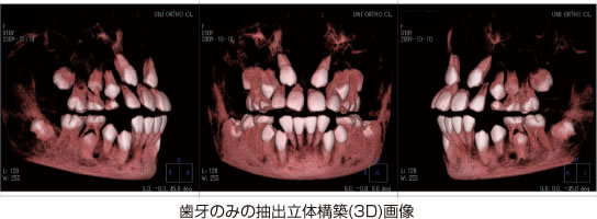 画像｜歯牙のみの抽出立体構築（3D）画像