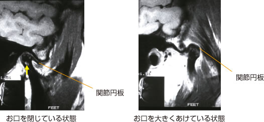 画像｜埋伏歯レントゲン写真