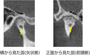画像｜顎関節のCT画像