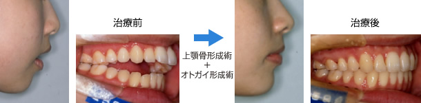 画像｜上顎前突（出っ歯）および開咬