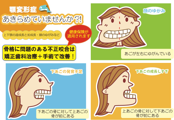 画像｜顎変形症のポスター
