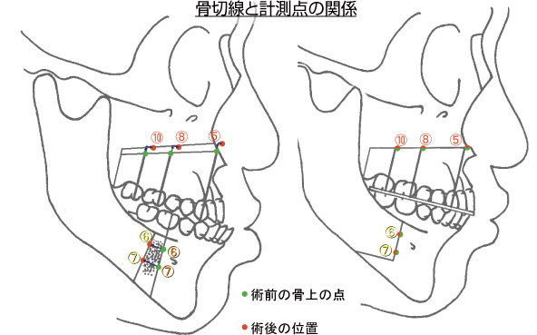 画像｜骨切線と計測点の関係