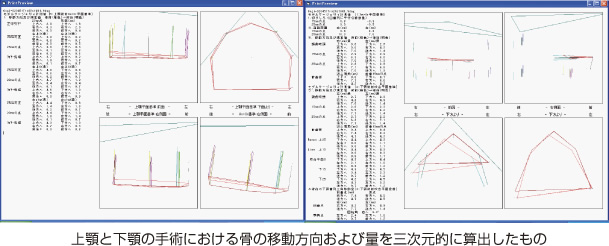 画像｜上顎と下顎の手術における骨の移動方向および量を三次元的に算出したもの