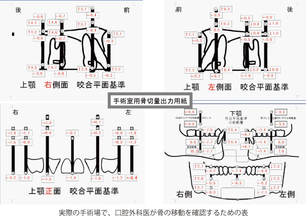 画像｜手術室用骨切量出力用紙
