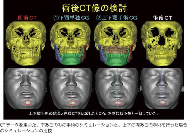 画像｜術後CT像の検討