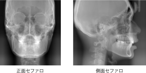 画像｜正面･側面セファロ