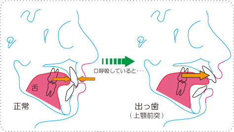 画像｜口呼吸による影響