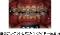 画像｜審美ブラケット ホワイトワイヤー装着