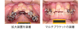 画像｜審美ブラケット ホワイトワイヤー装着1