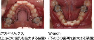 画像｜審美ブラケット ホワイトワイヤー装着1