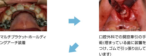 画像｜開窓牽引の経過1
