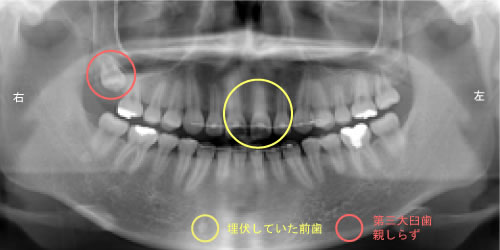 画像｜レントゲン写真 治療後
