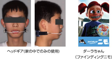 画像｜ヘッドギア装着