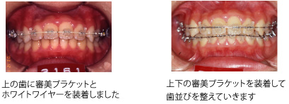 画像｜ヘッドギア