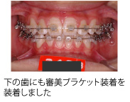 画像｜叢生 治療の組み合わせ例
