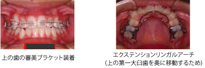 画像｜叢生 治療の組み合わせ例