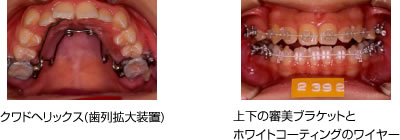 画像｜開咬 治療経過